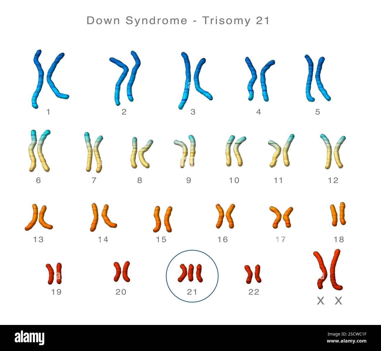 Karyotype Of A Woman With Down S Syndrome Trisomy 21 Showing An Additional Twenty First Chromosome A Normal Set Of Chromosomes Contains Only Two Of Each Chromosome Stock Photo Alamy Trisomy Of Chromosome 21 Stock Vector Illustration Of Number 159581013