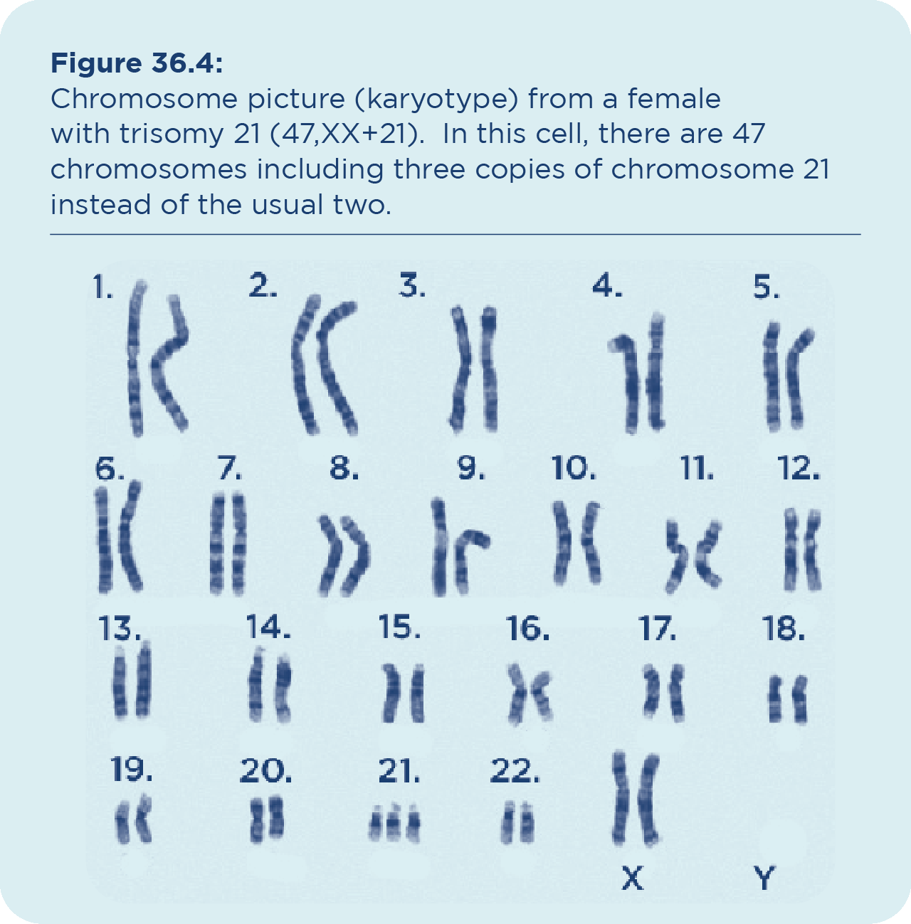 Trisomy 21 Down Syndrome Trisomy 21 Down Syndrome