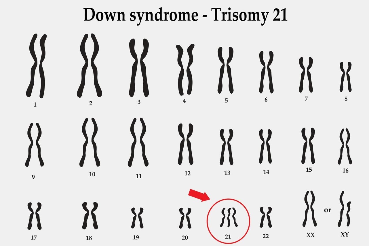 Trisomy 21 The ObG Project Trisomy 21 The ObG Project