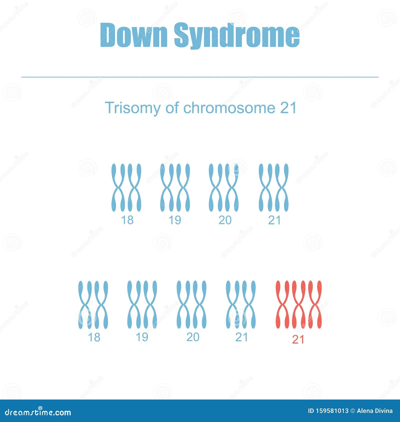 Trisomy Of Chromosome 21 Stock Vector Illustration Of Number 159581013 Trisomy Of Chromosome 21 Stock Vector Illustration Of Number 159581013